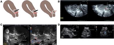 Management of cesarean scar pregnancy: Importance of gestational age at diagnosis and disease type—A single center’s 5 years of experience involving 223 cases